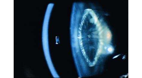 What Is Zonular Cataract Obn