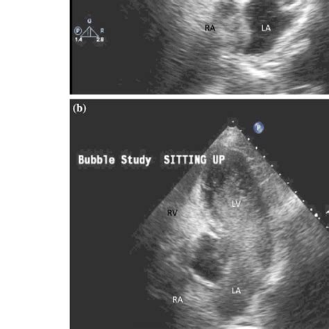 Transthoracic Echocardiogram Bubble Study In A Supine Position And