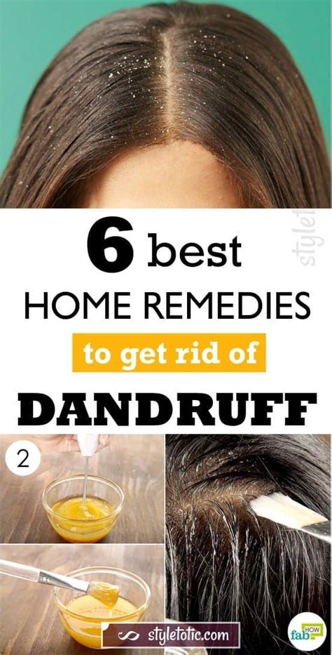 6 Best Home Remedies To Get Rid Of Dandruff For Good Home Remedies