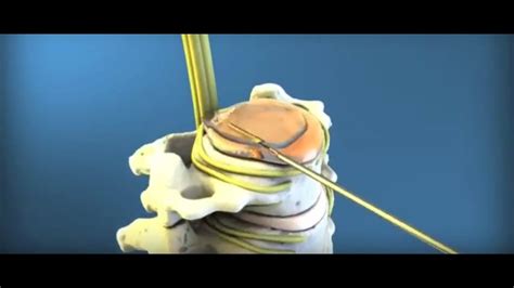 Minimally Invasive Laser Spine Procedure Cervical Discectomy With