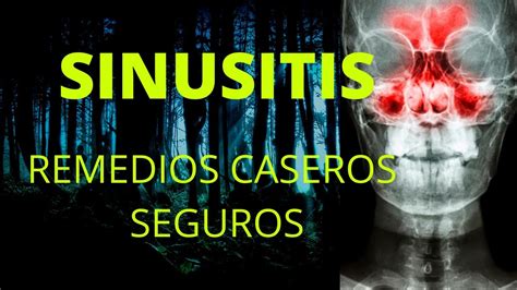 Sinusitis Remedios Caseros Seguros Youtube
