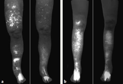 Microsurgical Treatment Of Lymphedema Plastic Surgery Key