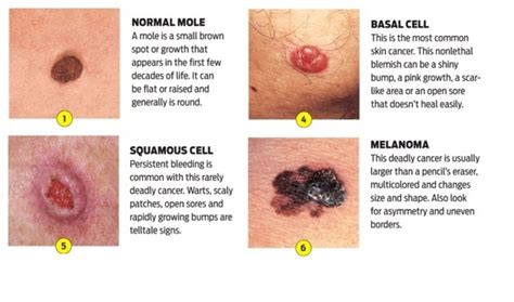 Things You Should Know About Skin Cancer Hubpages