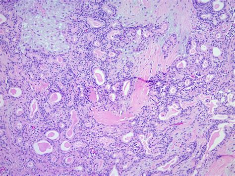 Image14 Chondroid Syringoma Skin Nonmelanocytic Tumors Flickr
