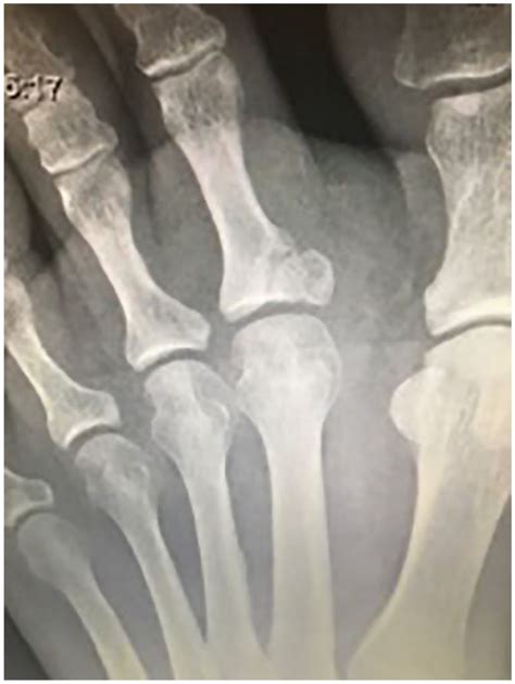 Case Report And Surgical Technique Second Toe Intra Articular Proximal