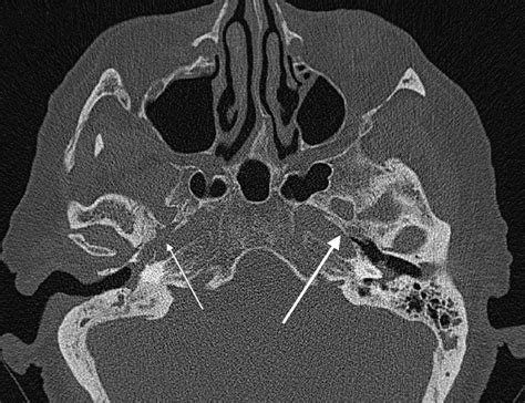 HR CT Scan Of The Temporal Bone Right Sided Carotid Canal Dehiscence