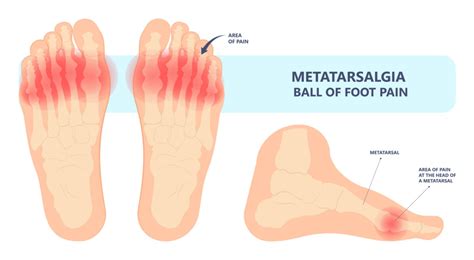 Metatarsalgia And Ball Of Foot Pain Powerstep