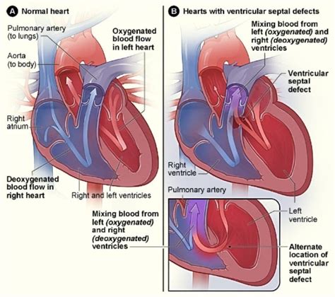 Congenital Heart Disease Chd Symptoms Causes Treatment Disabled