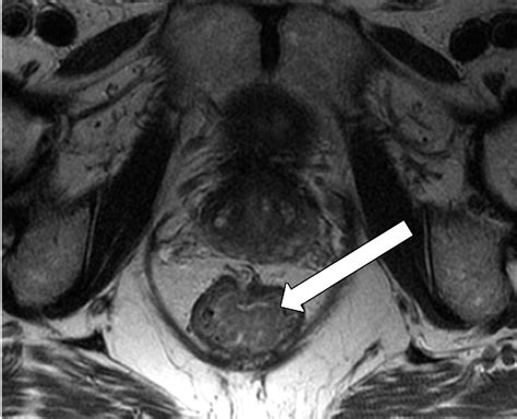 Mri Of Rectal Cancer Tumor Staging Imaging Techniques And Management Radiographics