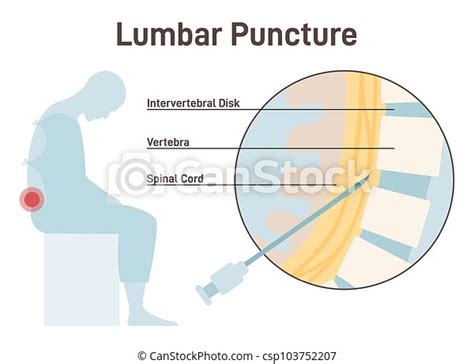 Lumbar Puncture Spinal Tap Needle Insertion Into The Space Between