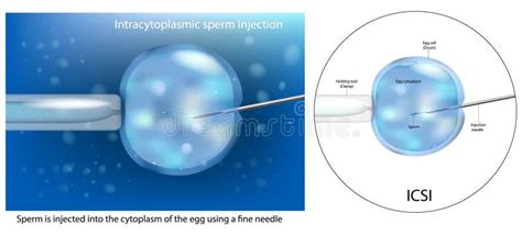 The Procedure Of Intracytoplasmic Sperm Injection Icsi Artificial Insemination In Vitro