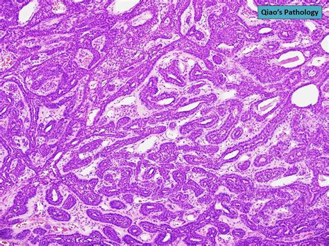 Qiao S Pathology Basal Cell Adenoma Of The Parotid Gland A Photo On