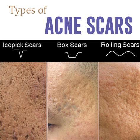Acne Acne Scars Healthsprings