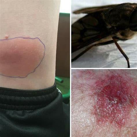 Horse Fly Bite Infection