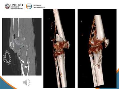 Fracturas Extremo Distal de Fémur YouTube