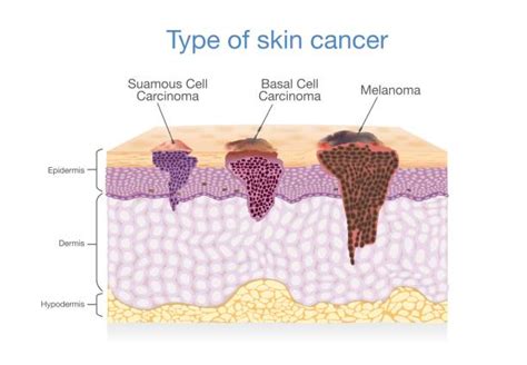Skin Cancer Illustrations Royalty Free Vector Graphics And Clip Art Istock