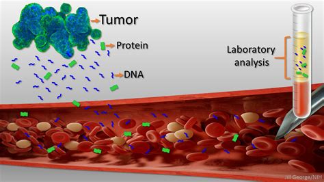 New ‘liquid Biopsy Shows Early Promise In Detecting Cancer Exosome Rna