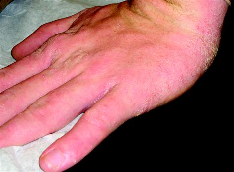 Hand Dermatitis Review Of Etiology Diagnosis And Treatment