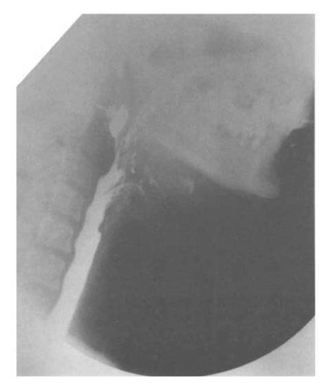 Barium Swallow Demonstrating Fistula Connecting Right Submandibular