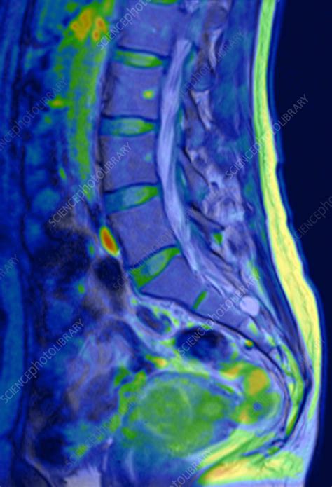 Healthy Lower Spine Mri Scan Stock Image F0394354 Science Photo