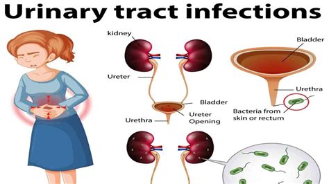 Actionable Urinary Tract Infection Treatment Tips That Work Like A