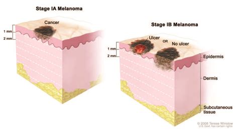 Melanoma Stages Stages Of Melanoma In Situ Stage 0 To Iv Advanced