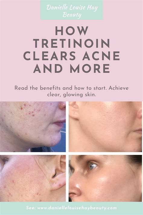 Pin By Iulia Dobos On Skincare Tips Tretinoin Tretinoin Acne Obagi