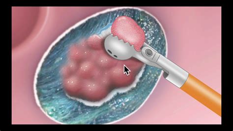 Colonoscopy Tethered Polyp Resection Graphic Illustration Youtube