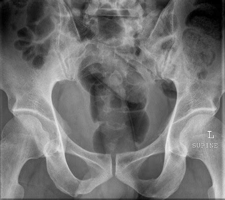 Body Packing Radiology Reference Article Radiopaedia Org