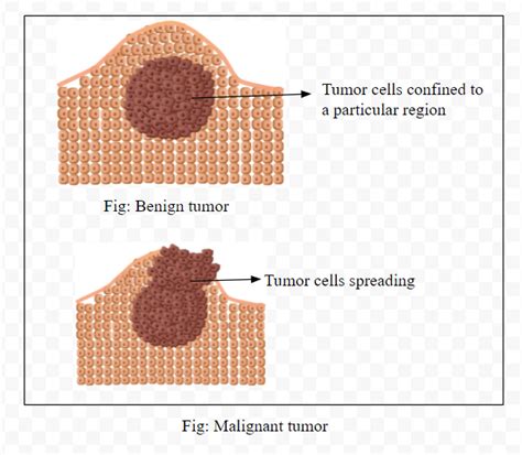 Differentiate Between Benign Tumor And Malignant Tumor