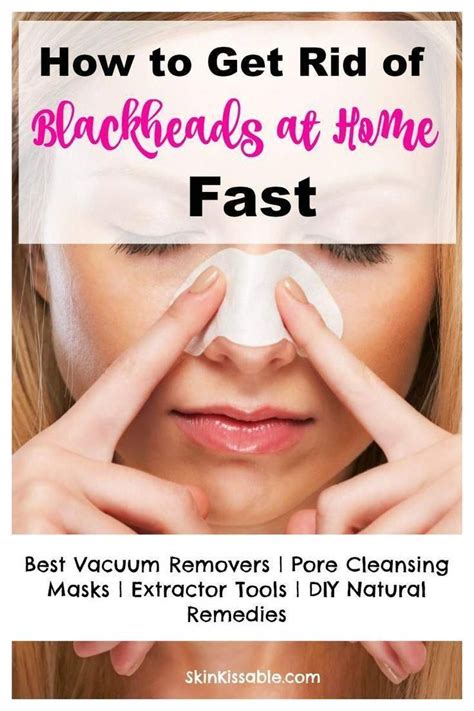 How To Get Rid Of Blackheads On The Face Nose And Chin With Diy Home