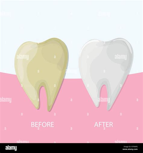 Teeth Whitening Stock Vector Images Alamy