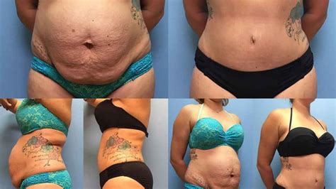 Before And After Lipo Before And After