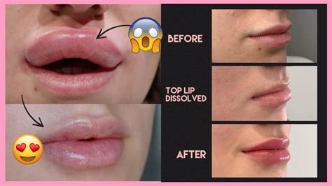 Juvederm Lips Before And After Syringe