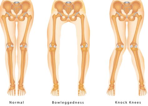 Knock Knees Causes Signs Symptoms Diagnosis And Knock Knees Treatment
