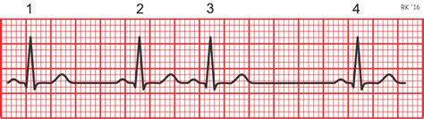 Cv Physiology Determining Heart Rate From The Electrocardiogram