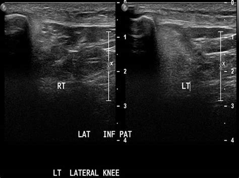Hoffas Fat Pad Impingement Syndrome Ultrasound Image