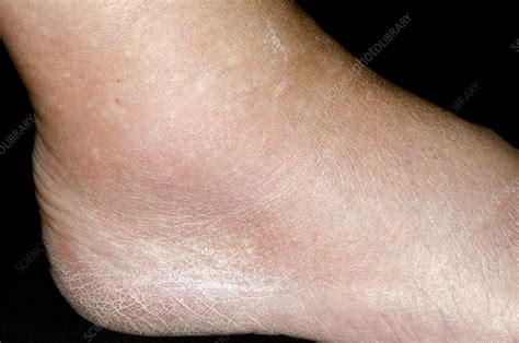 Gout In The Ankle Stock Image C Science Photo Library