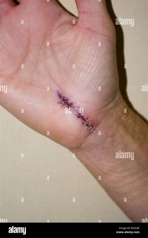 Medical Stitches Hand Hi Res Stock Photography And Images Alamy