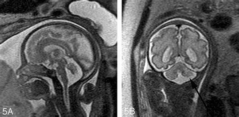 Magnetic Resonance Imaging Of The Fetal Brain And Spine An Increasingly Important Tool In