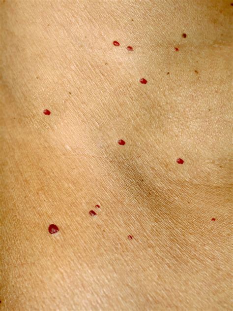 Hemangioma Cherry Angioma Vs Petechiae Small Red Spots On Vag Lips