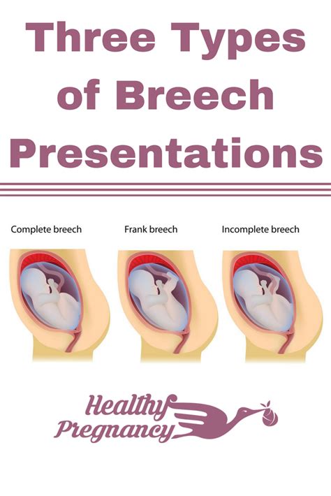 Three Types Of Breech Presentations Baby