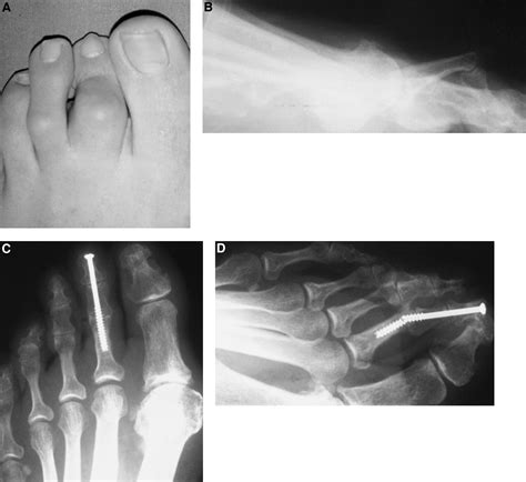 Arthrodesis Of The Toe Joints With An Intramedullary Cannulated Screw