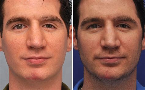 Scar Removal Before After Photos Annapolis Md