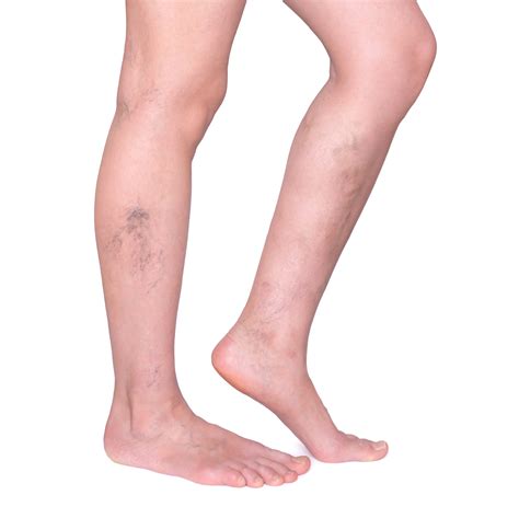 Varicose Veins 6 Things You Need To Know Irish Examiner