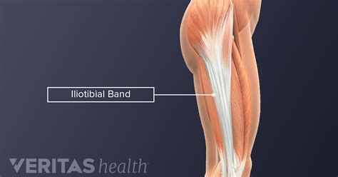 Proximal It Band Syndrome