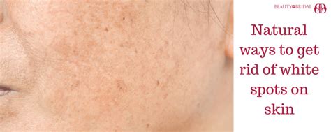 White Spots On Skin Treatment And Vitiligo Causes And Vitiligo Symptoms