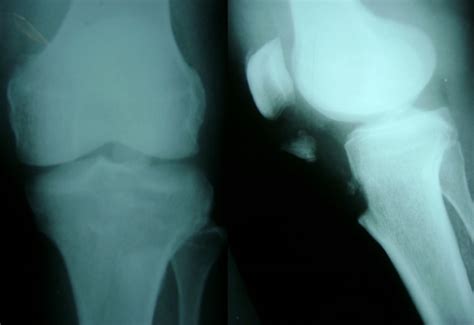 Fracture Of Tibial Tuberosity In An Adult Bmj Case Reports