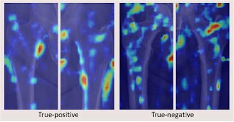 Ai Model Diagnoses Osteoporosis On Hip X Rays Radiology Ai