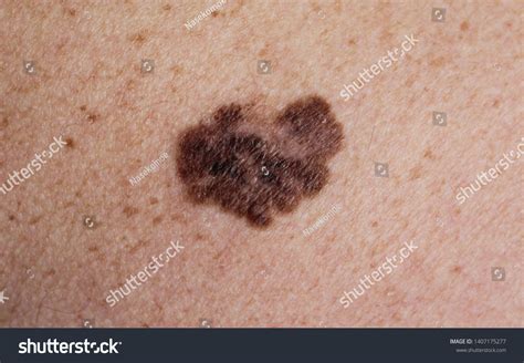 16 242 And Melanoma Images Stock Photos Vectors Shutterstock